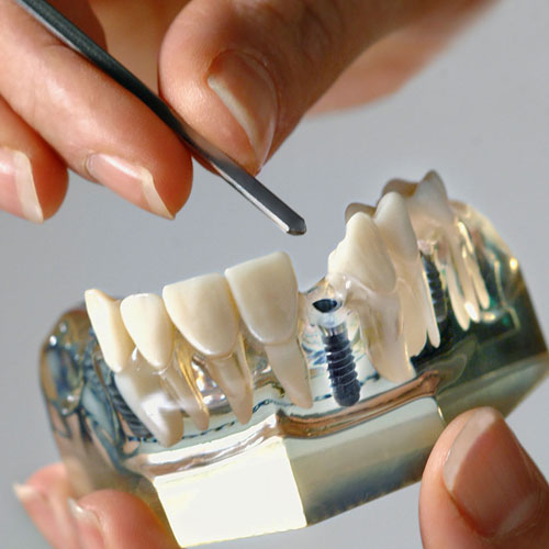 Implantatmodell. Foto Dietrich Hackenberg - www.lichtbild.org